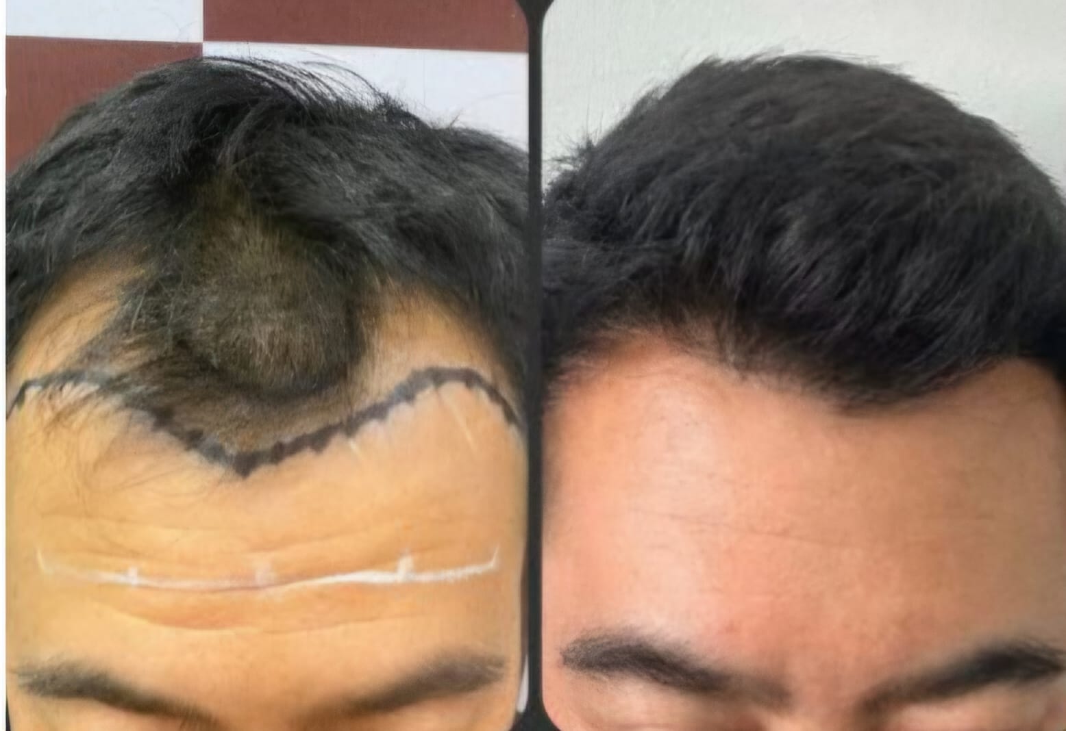 Marcação da linha frontal desenhada à mão antes da cirurgia, ao lado do resultado